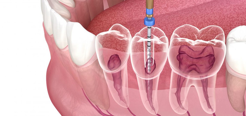 root canal treatment near you